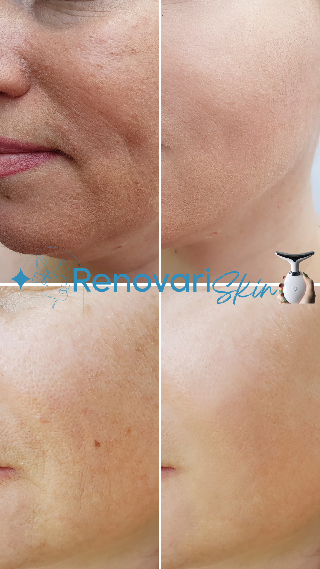 Removedor Avançado - Led Vibração ( Anti-Rugas / Massageador)