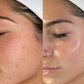 Máscara Facial LED - Controle de Acne