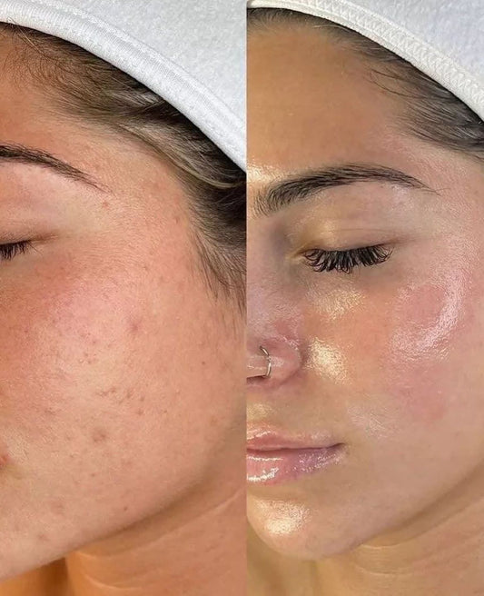 Máscara Facial LED - Controle de Acne
