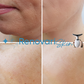 Removedor Avançado - Led Vibração ( Anti-Rugas / Massageador)